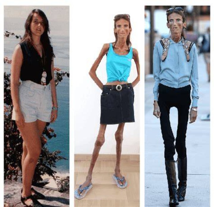 Exploring the Life and Journey of the Skinniest Person: Inspiring Stories and Insights